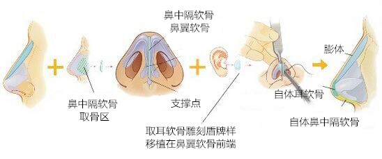 万州华美紫馨做鼻子怎么样8682.cc