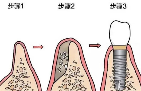 需要植骨粉做种植牙的步骤