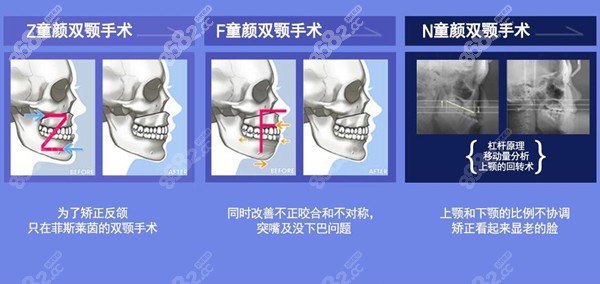 韩国菲斯莱茵整形医院双鄂手术