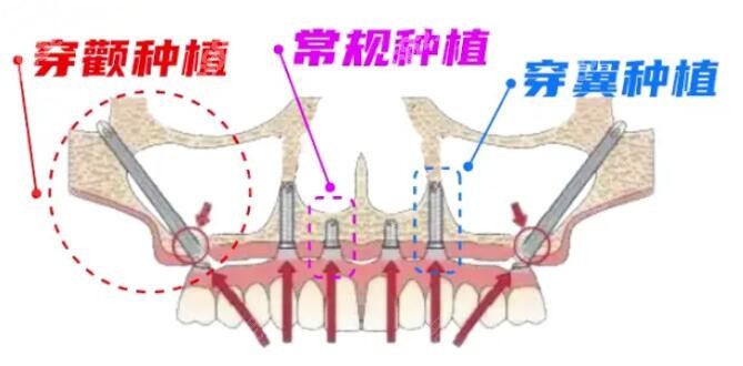 穿颧穿翼种植图解8682.cc