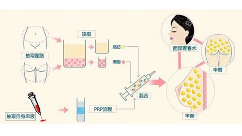 隆胸技术