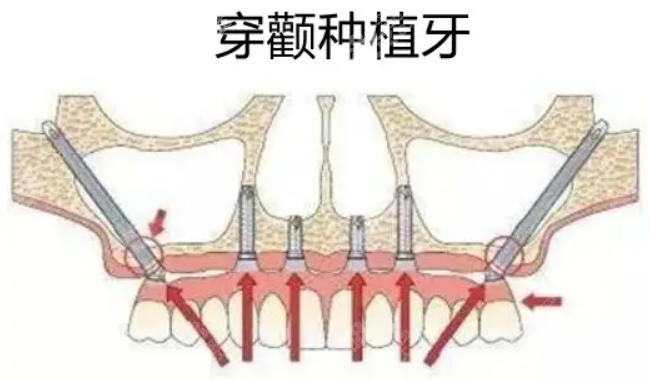 穿颧穿翼种植技术8682.cc