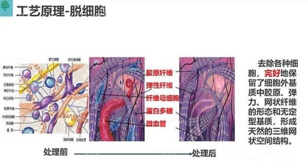 3d生物束带紧缩术工作过程及原理
