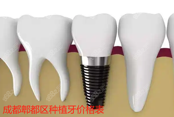 成都郫都区种植一颗牙价格表