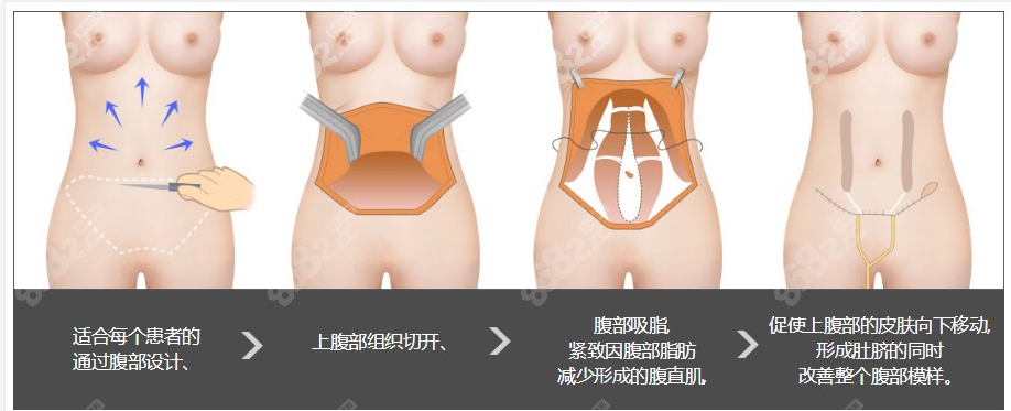 腹部拉皮手术过程示意图