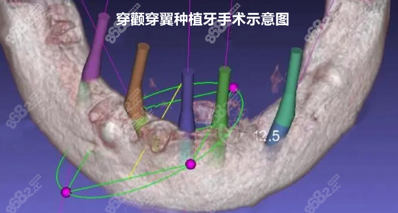 穿颧穿翼种植牙示意图