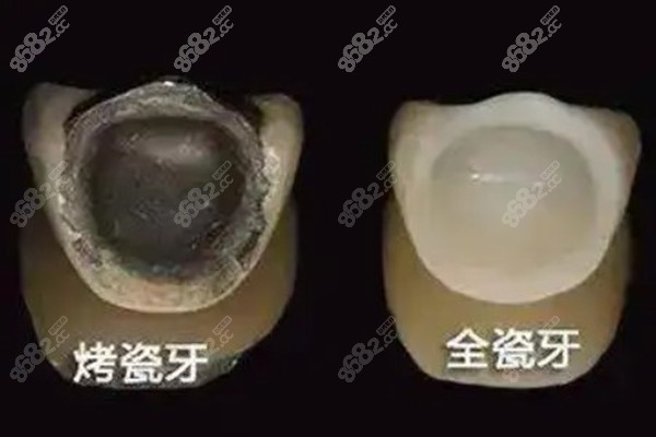 烤瓷牙和全瓷牙的图