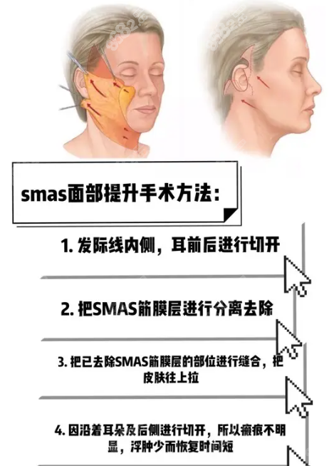 smas面部提升手术方法