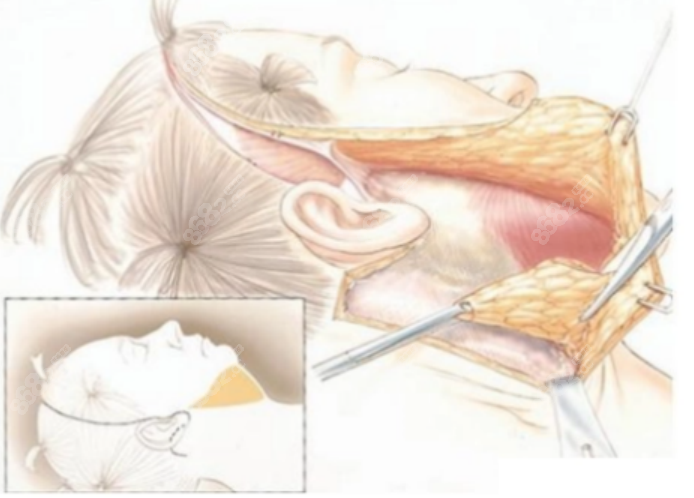 拉皮手术http://www.8682.cc/