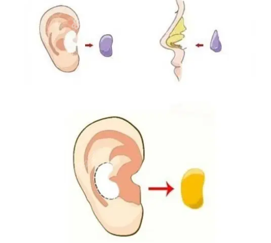 長(zhǎng)沙李源海耳軟骨隆鼻價(jià)格