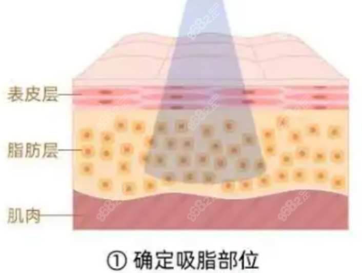 吸脂手术