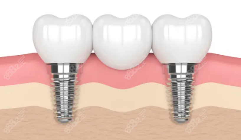 口腔拆桥改种植牙好吗？