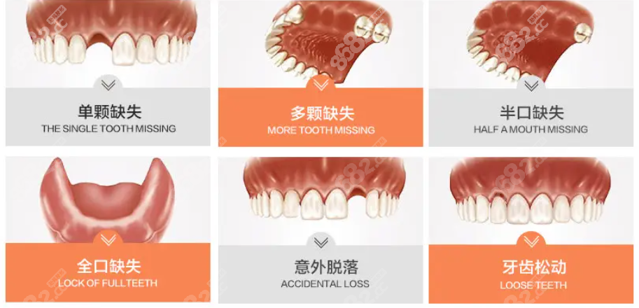 株洲贝壳口腔满口种植牙费用