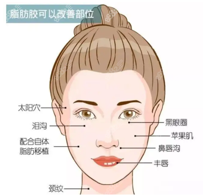 脂肪填充手术