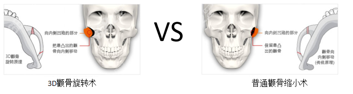 3D颧骨旋转术和普通颧骨缩小术的区别对比图