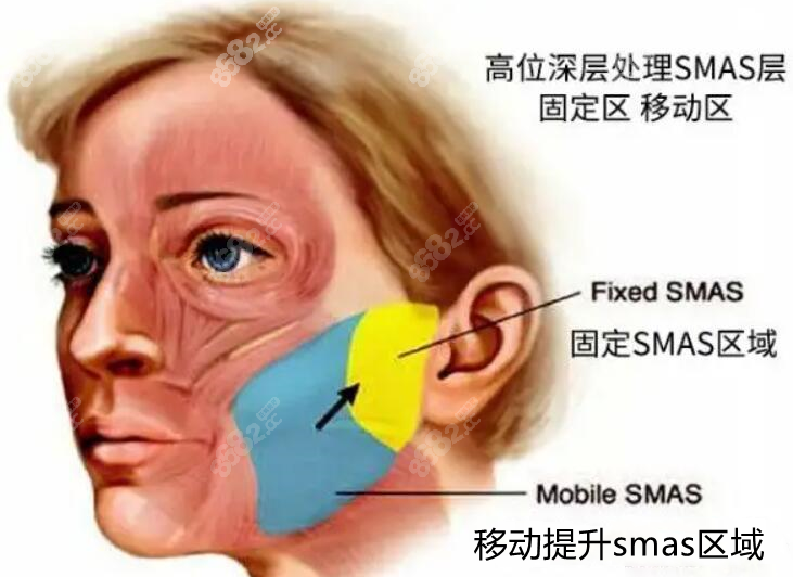 smas面部提升手术图示8682.cc