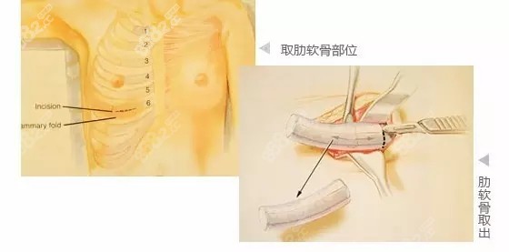 超体隆鼻和肋骨鼻哪个好