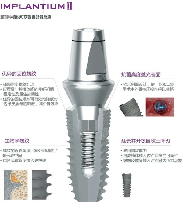 登腾种植牙4000和8000的有区别吗