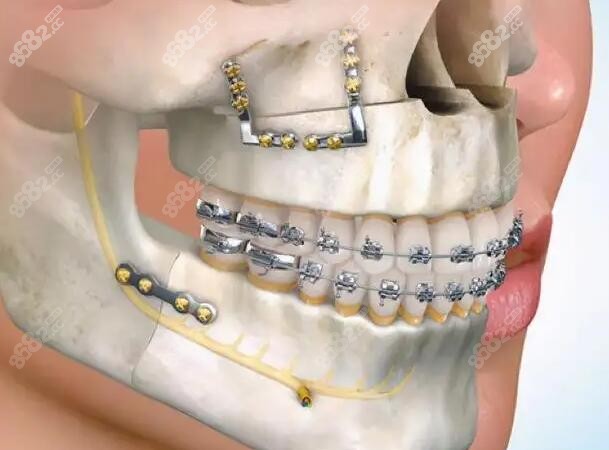 正颌手术是可以直接做的