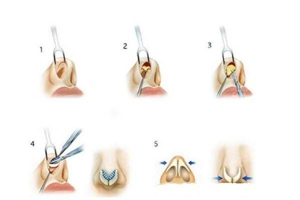 膨体隆鼻手术的示意图