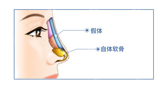 硅胶加耳软骨隆鼻能维持多久