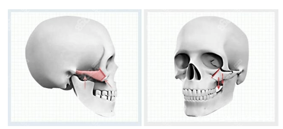颧骨整形手术过程示意图