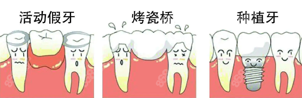 镶牙和种牙哪个比较好www.8682.cc