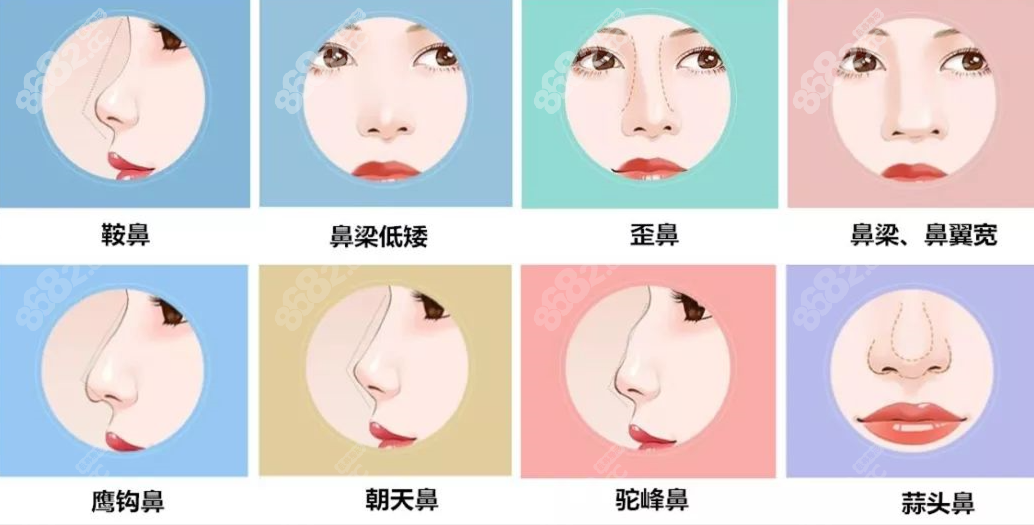 韩国鼻综合手术类型