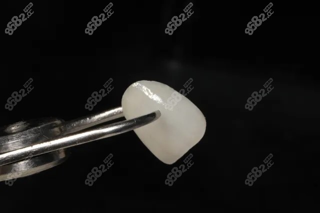 临汾做树脂贴面的价格和类型