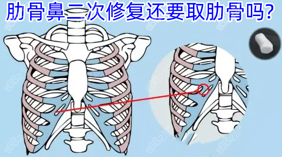 肋骨鼻二次修复还要取肋骨吗