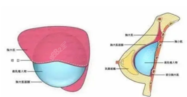 假体隆胸手术