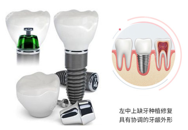 奉化种植牙价格表