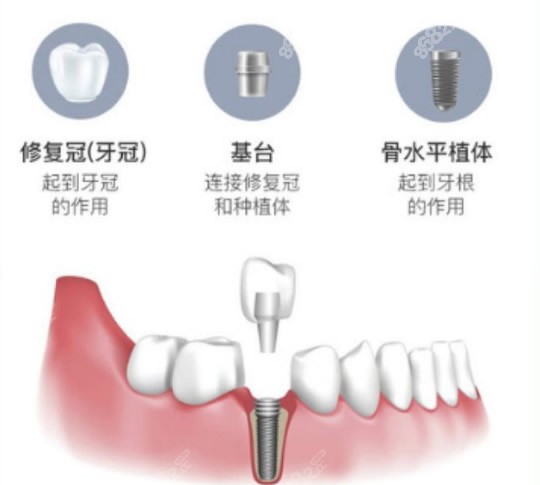 <!--<i data=20240705-sp></i>-->口腔种植牙怎么样