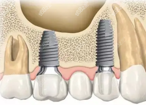 多颗连冠种植牙收费
