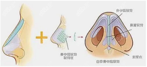 深圳十大鼻子整形医生排名