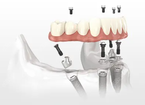 全口牙种植收费