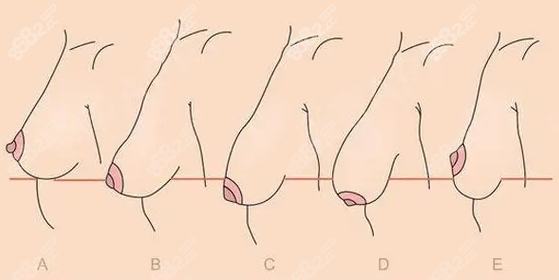 乳房下垂越厉害矫正的费用越高