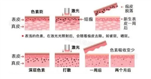 激光祛斑原理图