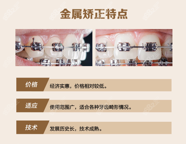 13-15岁中学生箍牙价格表www.8682.cc