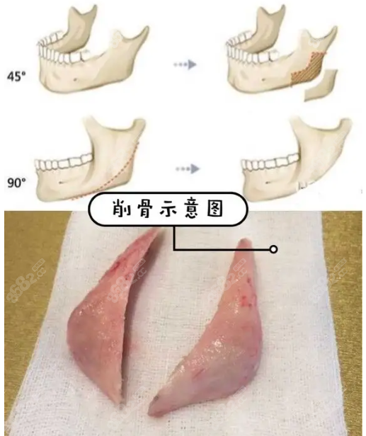 磨骨削骨手术示意图8682.cc