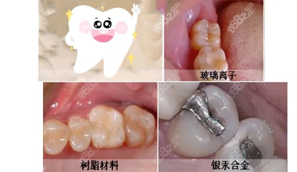 补牙材料如何选择