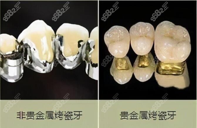 临汾做烤瓷牙的类型和价格www.8682.cc