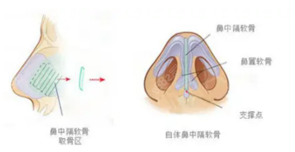 隆鼻手术