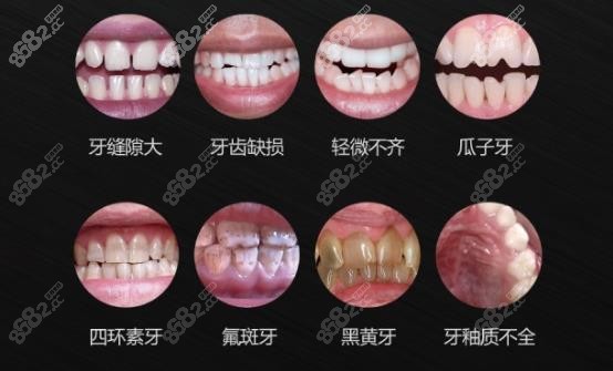泉州盛安口腔全瓷牙和牙齿贴面的价格