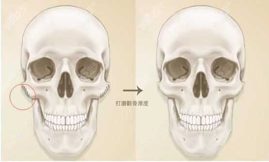 颧骨降低的手术方式