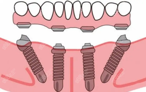 all-on-4种植牙示意图