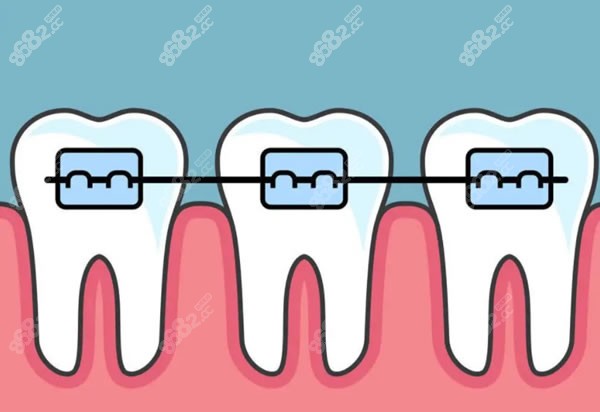 牙齿矫正卡通图