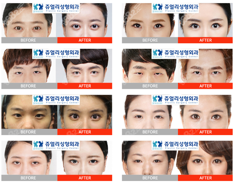 韩国珠儿丽整形外科眼修复对比图