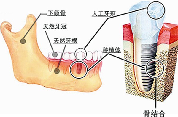 种植牙在牙槽骨内的图