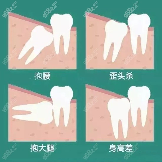 智齿一定要拔掉吗？影响到牙齿健康的要拔